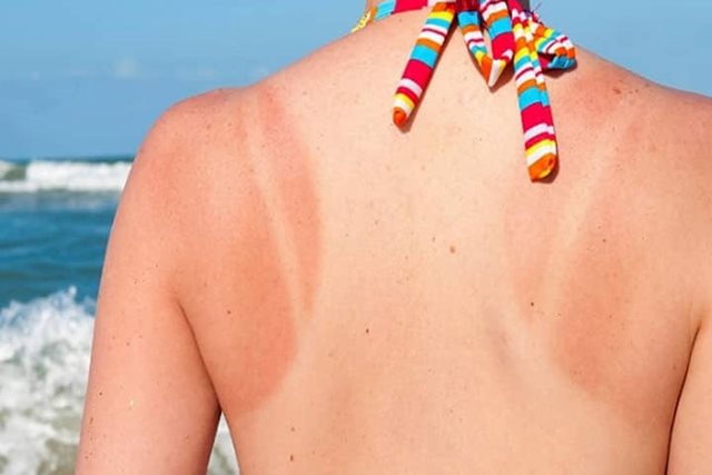 Cách phục hồi làn da sau rám nắng mùa hè